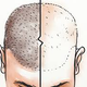 Illustration for article titled Hair Transplants: What to Expectem/em